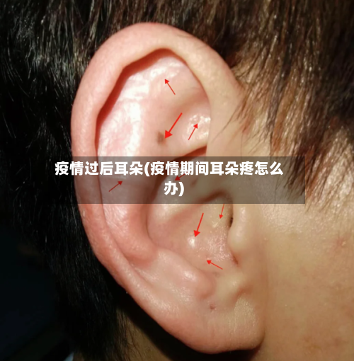 疫情过后耳朵(疫情期间耳朵疼怎么办)-第1张图片